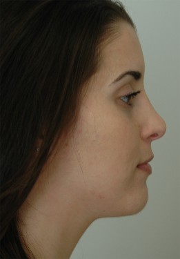 Rhinoplasty, nasal airway, nose surgery, nosejob, westport, fairfield