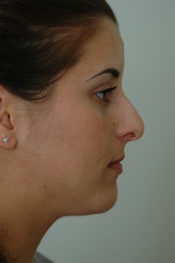 Pre Rhinoplasty